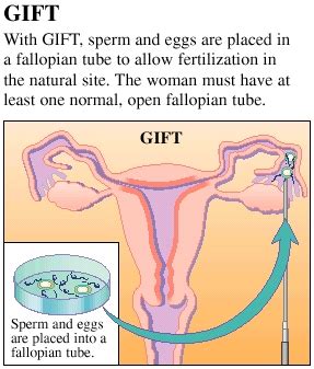 Gamete Intrafallopian Transfer (GIFT) - Women Health Info Blog