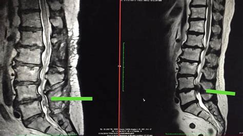 Mri Of Spinal Stenosis