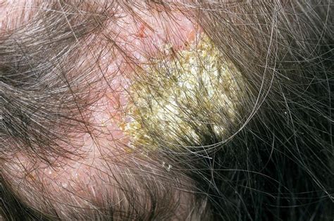 Infected Eczema On The Scalp Photograph by Dr P. Marazzi/science Photo Library