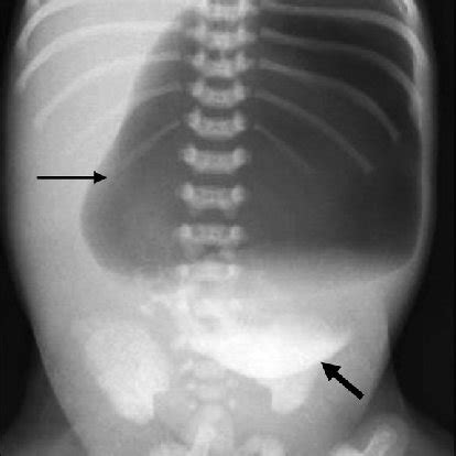 Plain abdominal radiograph with contrast material (urographin),... | Download Scientific Diagram