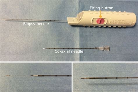 Image-guided Biopsy - Radiology at St. Vincent's University Hospital