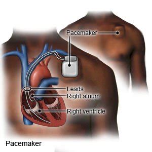 Pacemaker: Types and function