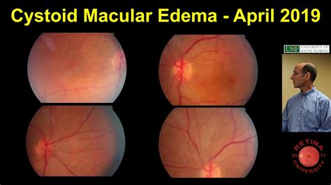 Cystoid Macular Edema - YouTube