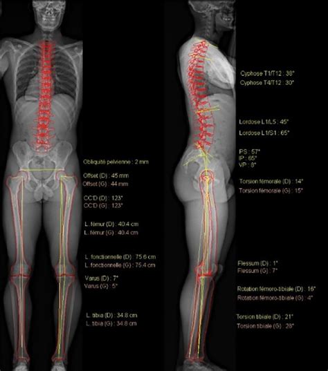 Full spine contouring on paired frontal and lateral views on an EOS... | Download Scientific Diagram