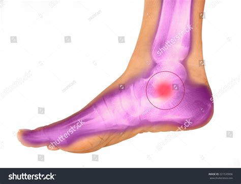 Foot Pain On Xray Stock Photo 221533006 | Shutterstock