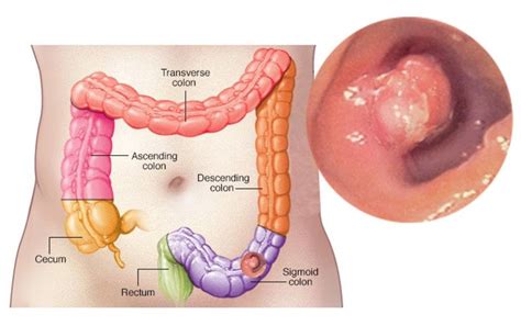 Colorectal Cancer - Healthy Kansas City