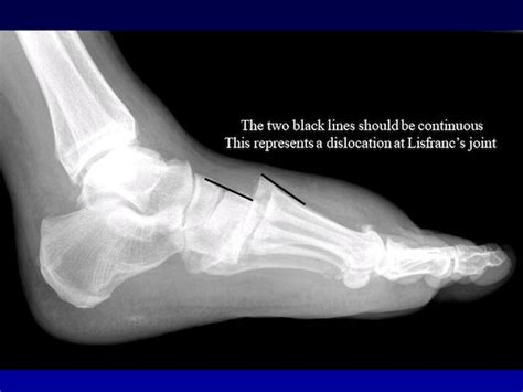 What is a Lisfranc injury and how come it sidelines athletes for so ...