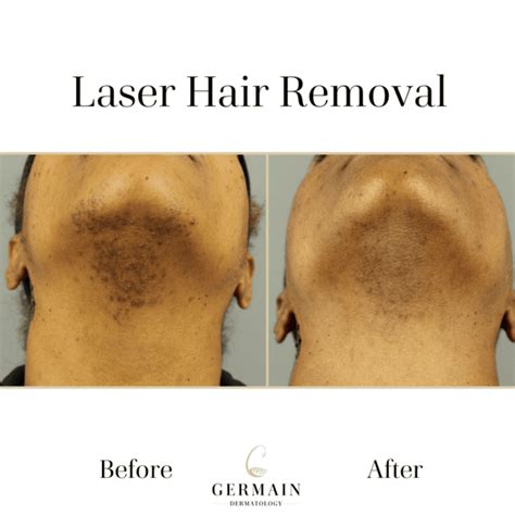 Laser Hair Removal Before & After | Mt Pleasant, Summerville