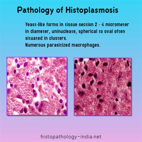 Pathology of Histoplasmosis | Pathology, Centers for disease control and prevention, Centers for ...