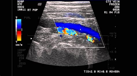 Introduction to the Lower Extremity Venous Doppler Study | Ultrasound, Diagnostic medical ...