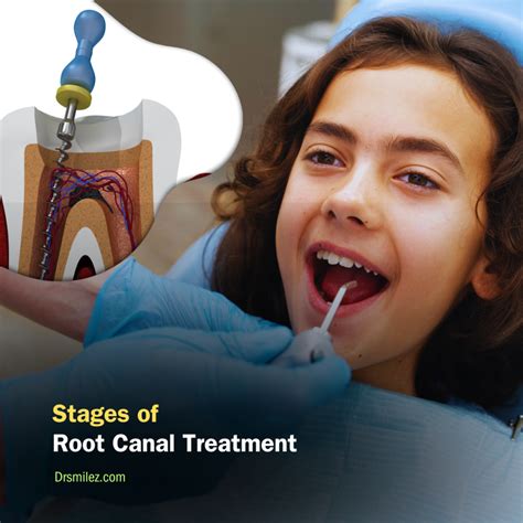 Unveiling the Different Stages of the Root Canal Treatment