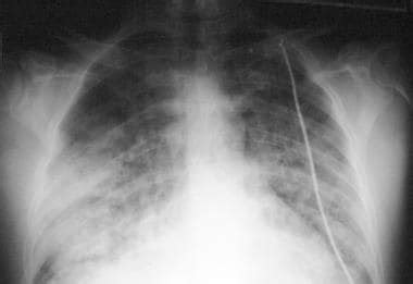 Pulmonary Edema Chest X Ray