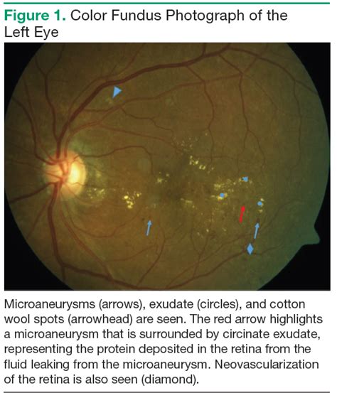 Diabetic Macular Edema: Is Your Patient Going Blind? | Federal Practitioner