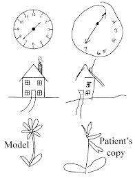 Image result for hemineglect syndrome | Science blog, How are you ...