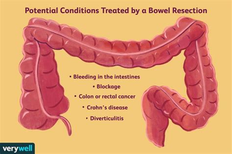 Bowel Resection Surgery: Purpose, Recovery, and More