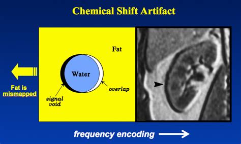 Chemical shift artifact - Questions and Answers in MRI