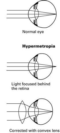 What is long-sightedness? State the two causes of long-sightedness (or hypermetropia).