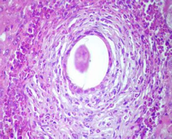 Schistosoma haematobium - Life Cycle, Pathogenesis, Pathology, Host Immunity