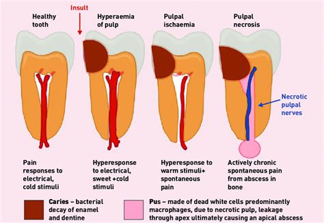 Schematic representation of progression of a lesion of dental caries... | Download Scientific ...