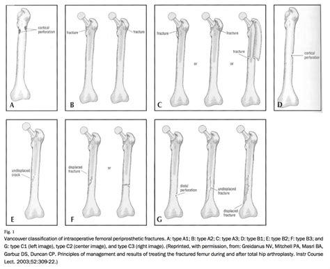 THA Periprosthetic Fracture - Recon - Orthobullets