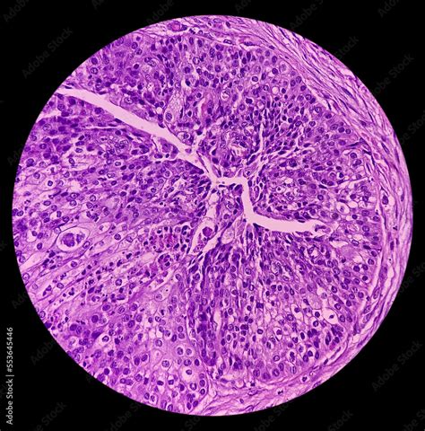 High grade mucoepidermoid carcinoma of parotid cyst. Microscopic show parotid tissue, features ...