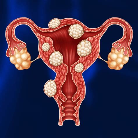 Uterine fibroids in women: why is it dangerous and how to treat it? | Uterine fibroids, Fibroids ...