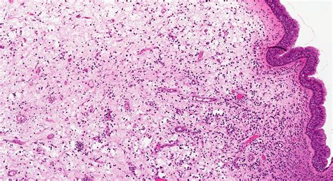 Pathology Outlines - Inflammatory sinonasal polyp