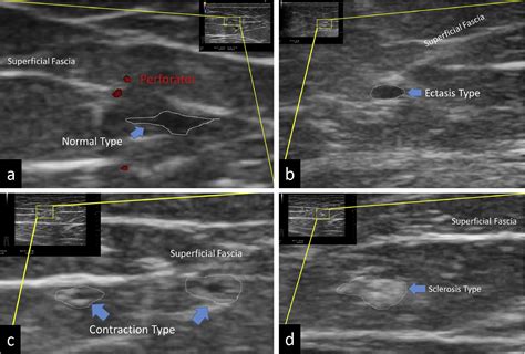 Ultrasonography for classifying lymphatic sclerosis types and deciding optimal sites for ...