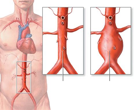 Aortic Aneurysm - Abdominal & Thoracic - Causes, Symptoms, Repair