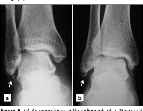 Figure 6 from The Accessory Ossicles of the Foot and Ankle; a Diagnostic Pitfall in Emergency ...