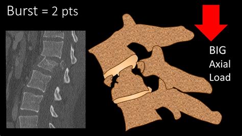 1/Remembering spinal fracture classifications is back breaking work! A #tweetorial to review the ...