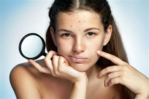 Homeopathy for Acne - Homeopathy Plus