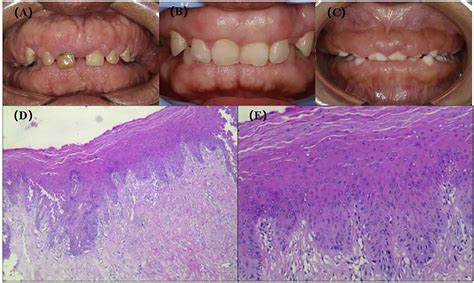 Frontiers | Case Report: A Case of Hereditary Gingival Fibromatosis ...