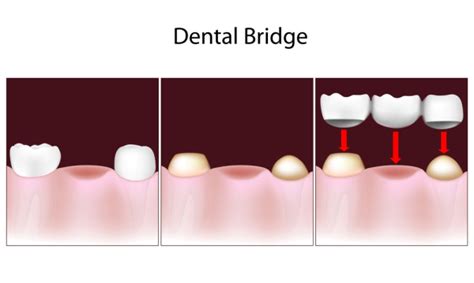 Fixed Bridges | Manchester, NH | Jason Sudati, DMD