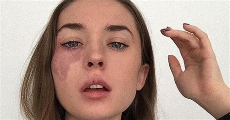 Woman with facial birthmark is going viral for her inspirational body ...