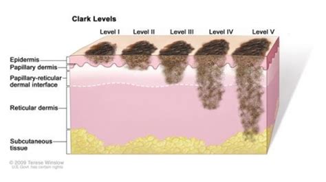 Malignant Melanoma - Physiopedia