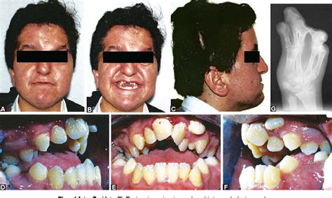 Figure 1 from Orthodontic and surgical treatment of a patient with ...