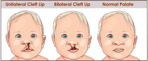 Cleft Palate: Causes, Treatment and Speech Therapy | Speech Blubs