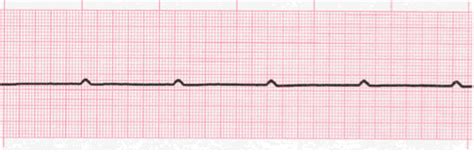 Ventricular Asystole - EKG Lesson #315