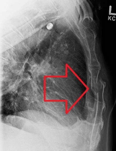 Sternal fracture - WikEM