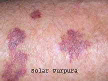 Orlando Solar Purpura Treatment | OrlandoSkinDoc