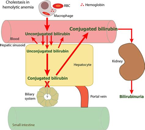 Bilirubin in a hemolytic anemia with cholestasis | eClinpath