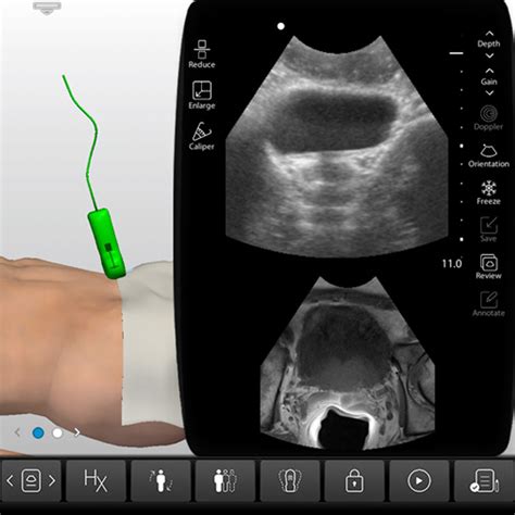 Prostate Anatomy Ultrasound