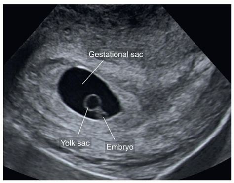 Yolk Sac 6 Weeks