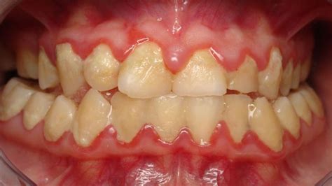 Plaque and your teeth - Waverley Oaks Dental | Gum disease, Healthy ...