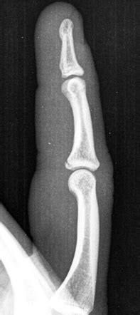 Volar Plate Fracture Radiology