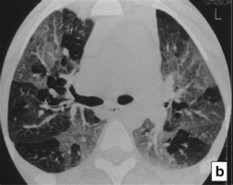 Bronchiolitis Obliterans | Concise Medical Knowledge