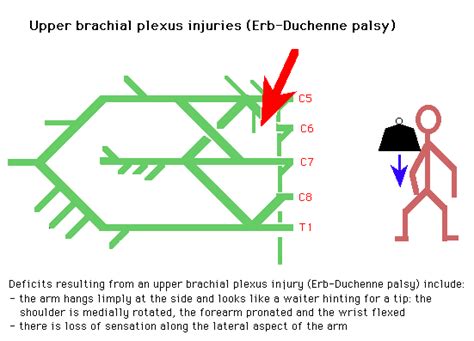 Diagram of Erb-Duchenne palsy – GPnotebook