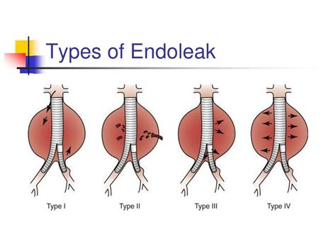 PPT - Abdominal Aortic Aneurysms PowerPoint Presentation - ID:488238