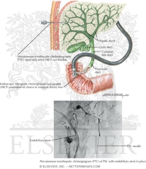 Cholangiography